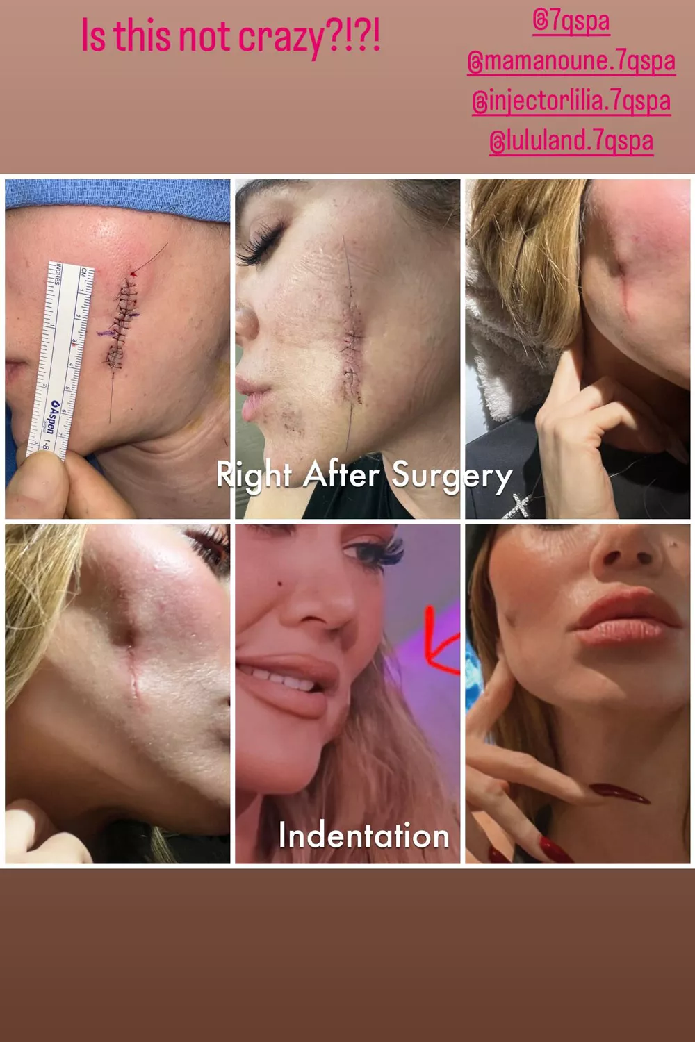 Khloe Kardashian shares before and after photos following skin cancer surgery